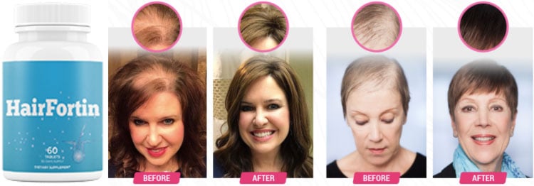 HairFortin Review